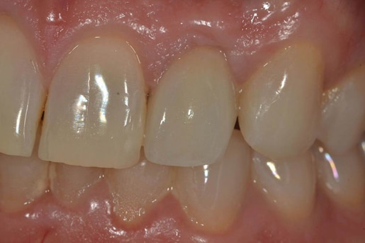 Patient smile after treatment at Young Dental Health Center