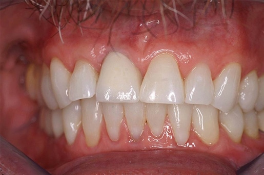 Patient smile after treatment at Young Dental Health Center