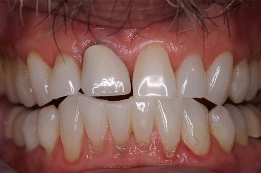 Patient smile before treatment at Young Dental Health Center