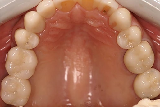 Patient smile after treatment at Young Dental Health Center