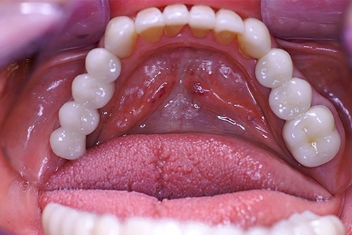 Patient smile after treatment at Young Dental Health Center