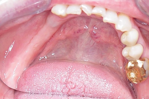 Patient smile before treatment at Young Dental Health Center