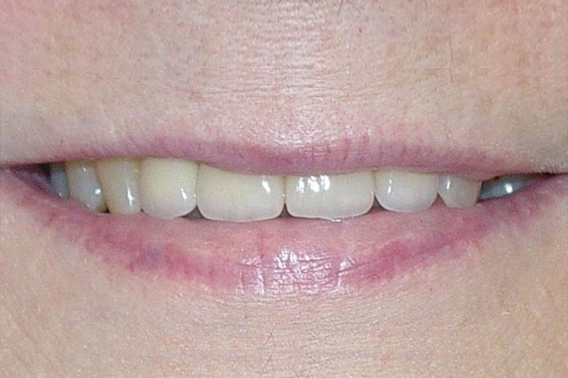 Patient smile after treatment at Young Dental Health Center