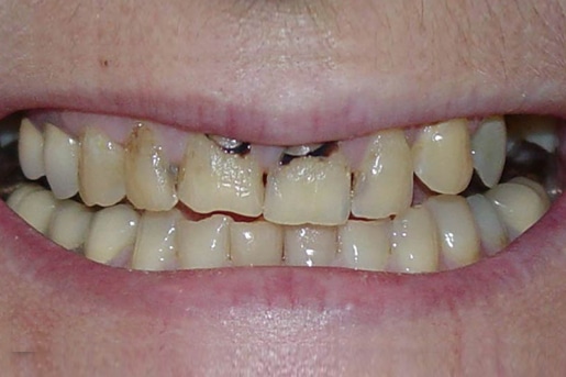 Patient smile before treatment at Young Dental Health Center
