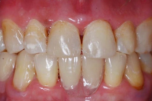 Patient smile after treatment at Young Dental Health Center