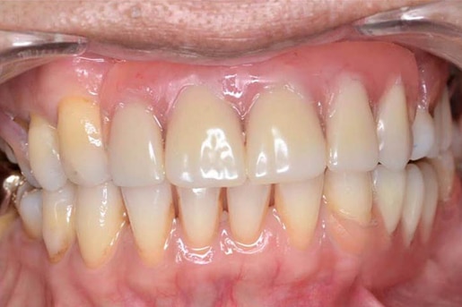 Patient smile after treatment at Young Dental Health Center