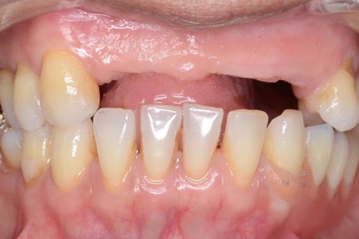 Patient smile after treatment at Young Dental Health Center