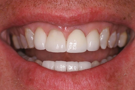 Patient smile after treatment at Young Dental Health Center