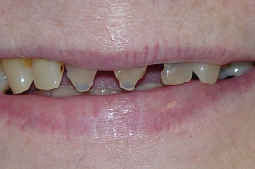 Patient smile before treatment at Young Dental Health Center