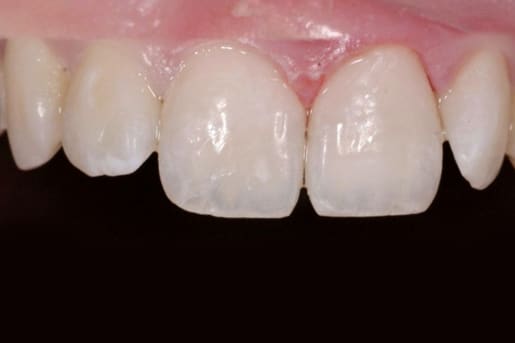 Patient smile after treatment at Young Dental Health Center
