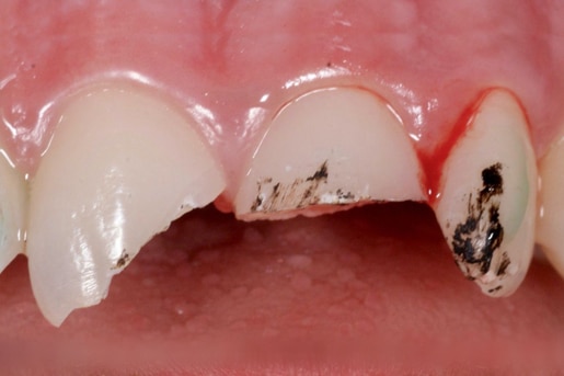 Patient smile before treatment at Young Dental Health Center