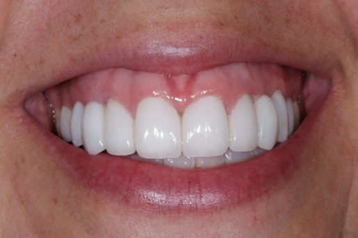 Patient smile after treatment at Young Dental Health Center