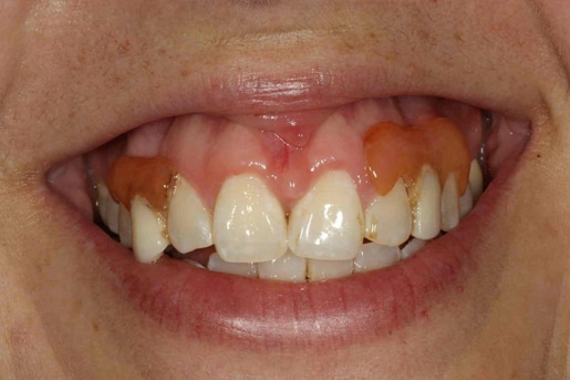 Patient smile before treatment at Young Dental Health Center