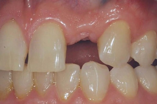 Patient smile before treatment at Young Dental Health Center